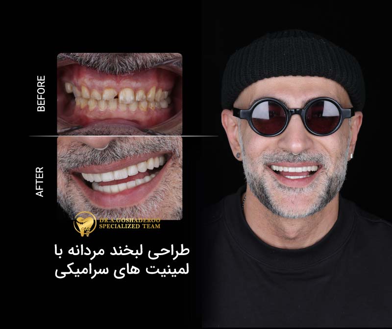 طراحی لبخند مردانه با لمینیت های سرامیکی